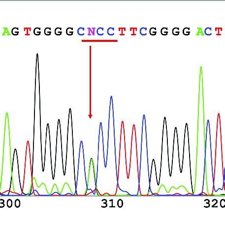 Direct Sequencing Of GCK Exon 7 A Novel Heterozygous Missense