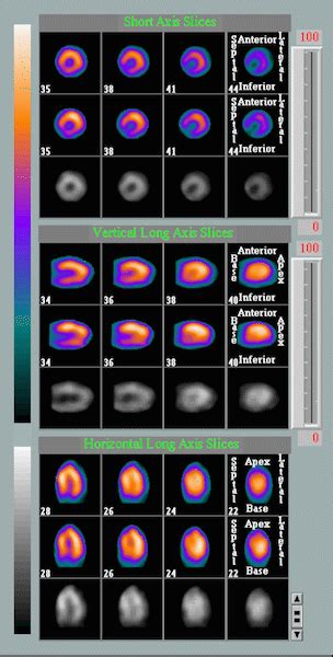 Nuclear Stress Test Cardiovascular Interventions Orlando