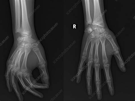 Healthy Hand X Ray Stock Image F Science Photo Library