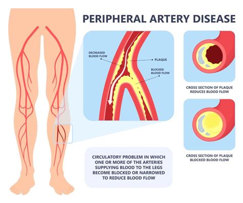 What Is Peripheral Arterial Disease Rocky Mountain Foot Ankle