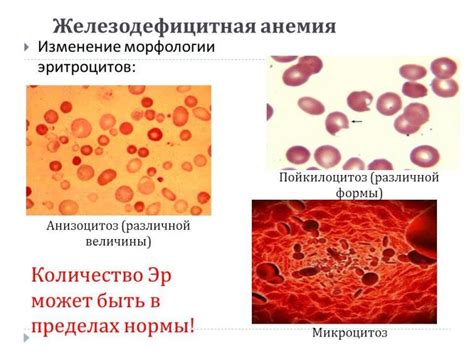 Железодефицитная анемия: симптомы, причины и лечение