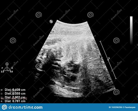 Ultrasound Scherm Met Foetale Echocardiografie Stock Foto Image Of