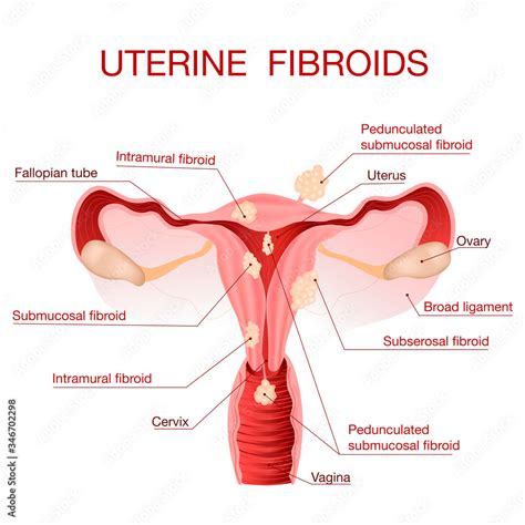 Uterine Fibroids A Schematic Illustration Of The Uterus Female