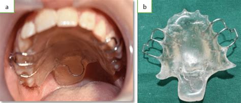 a: Palatal Lift appliance in-situ; b: Palatal lift prosthesis ex-situ ...