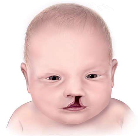 Cleft Palate & Cleft Lip - Causes, Symptoms, Repair, Surgery