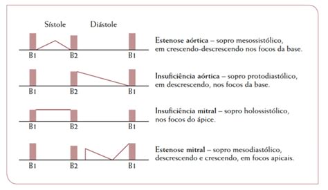 Tipos De Sopro No Coração - Sopros Cardíacos | Colunistas - Sanarmed