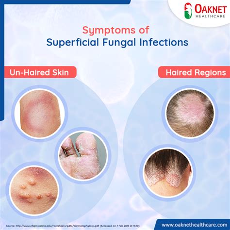 Symptoms of superficial fungal infections vary depending on the ...