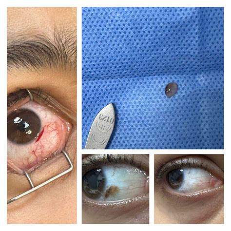 conjunctival naevus removal london hertfordshire essex