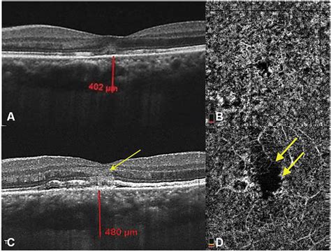 Comparison of horizontal B-scans of spectral-domain optical coherence ...