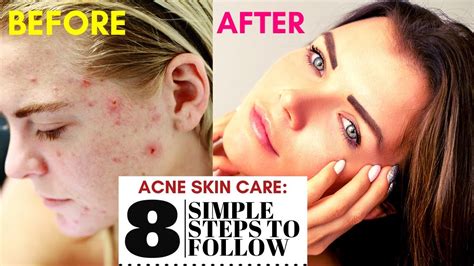 Acne Skin Care 8 Simple Tips To Follow Youtube