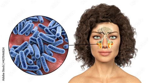 Inflammation Of Maxillary Sinuses In A Woman And Close Up View Of