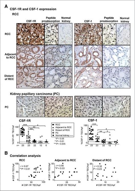 Autocrine Csf 1 And Csf 1 Receptor Coexpression Promotes Renal Cell Carcinoma Growth Cancer