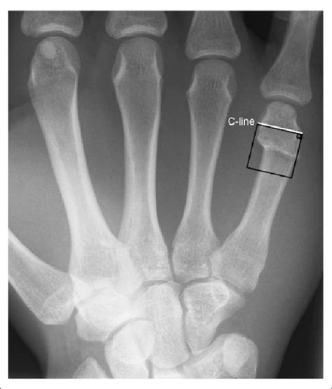 Metacarpal Shaft Fracture