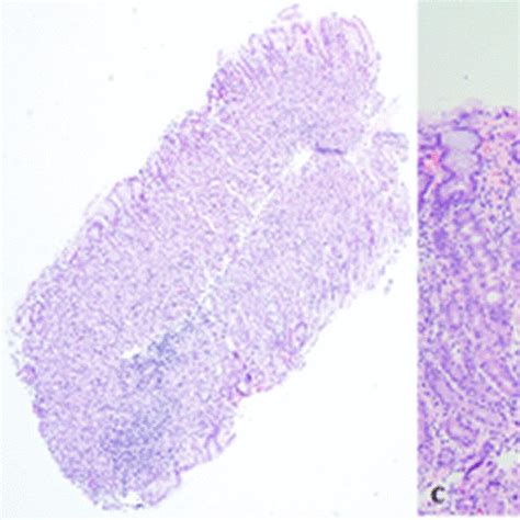 A Duodenal Biopsy Demonstrating Preserved Villous Architecture With