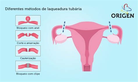 O Que Significa Laqueadura