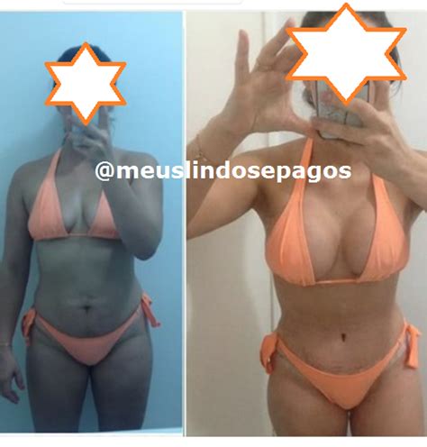 Meus Lindos E Pagos Arquivos Abdominoplastia Lipo Mastopexia