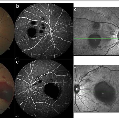 Fundus Photographs And Sd Oct Images Weeks After Nd Yag Laser