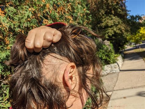 Alopecia eyebrows - dithranol/diphencyprone : r/alopecia_areata