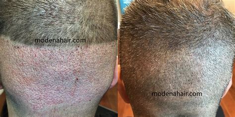 A Complete Guide To Hair Transplantation Scarring Modena Hair Institute