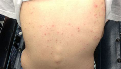 Derm Dx: An itchy eruption develops after soaking in a whirlpool ...