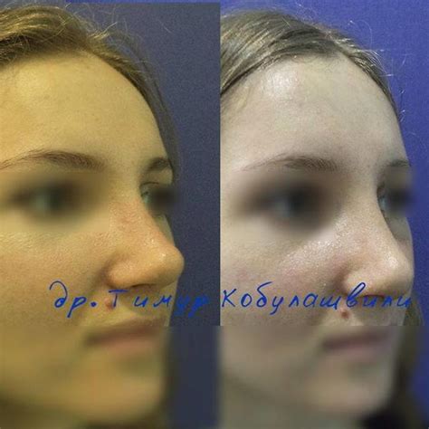 Rhinoplasty Before After Big Nose 2 Rhinoplasty Cost Pics