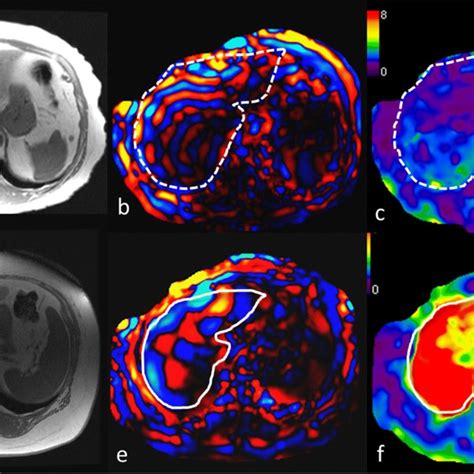 Mr Elastography In Two Patients With Nafld Top Row A Year Old