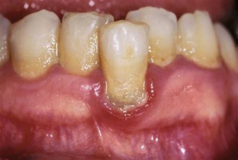 4 Microbiology Of Periodontal Diseases Pocket Dentistry