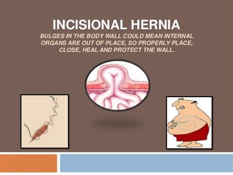 Abdominal Incisional Hernia Repair