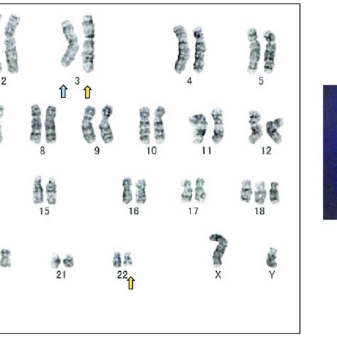 Cytogenetic Findings Of Lymphoma Cells A G Banded Karyotype Arrows