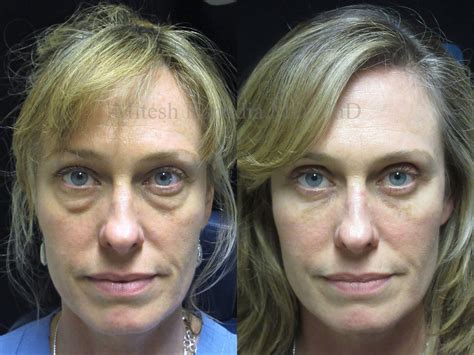 Upper And Lower Eyelid Surgery Before And After Photos You - Infoupdate.org