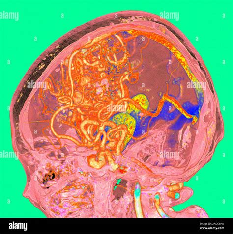 Cerebral Arteriovenous Malformation Digitally Enhanced D Computed