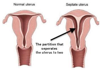 Septate Uterus (Uterine Septum): Symptoms Treatment, 59% OFF