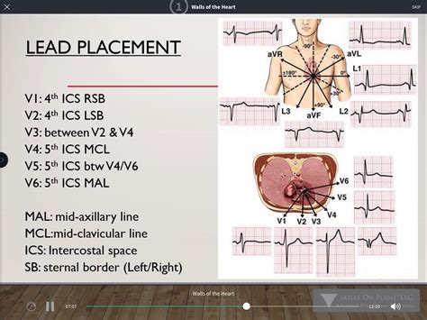 How To Interpret Stemi 12 Lead Ecg And Correlate It With Coronary ...