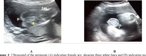 Figure 1 From Ultrasound Accuracy In Determining Fetal Sex And Weight Performed By Experienced