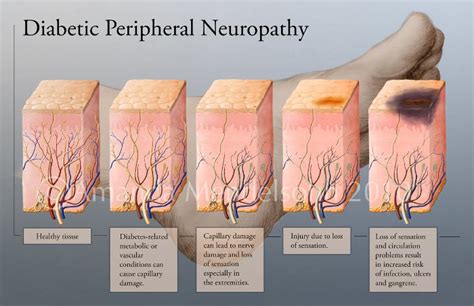 Diabetic Peripheral Neuropathy