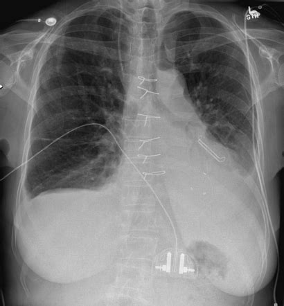 External Left Atrial Appendage Closure Device Atriclip Radiology