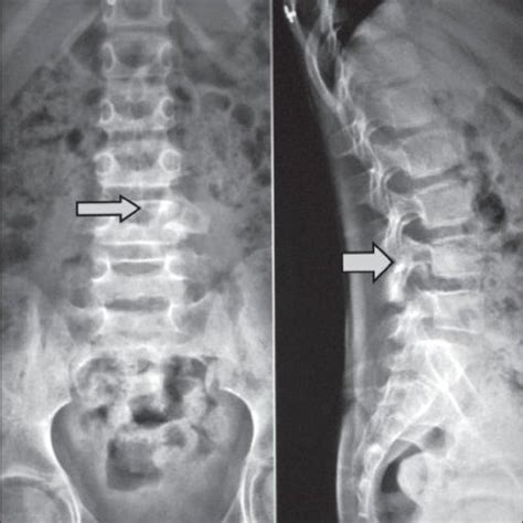 Computed tomography scan images shows expansive osteolytic lesion with... | Download Scientific ...