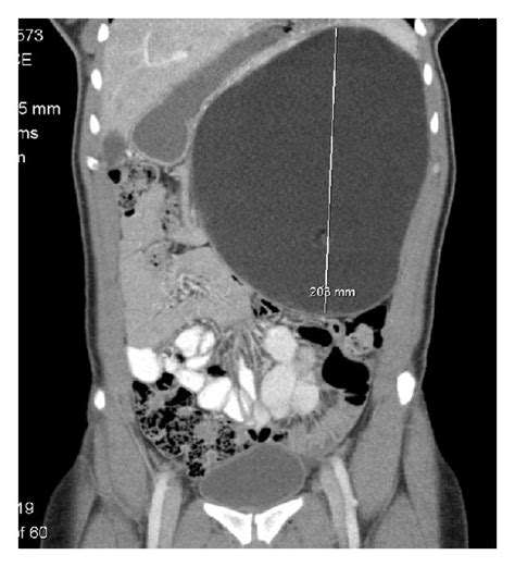 The Giant Teratoma At Laparotomy A And B And After Excision C