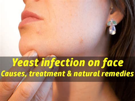 Yeast infection on face: Causes, treatment & natural home remedies