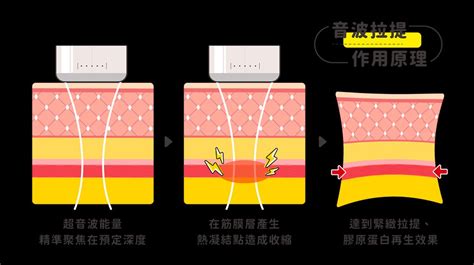 分享 四年電波、音波施打簡單心得 醫美板 Dcard