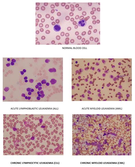 leukemia   acute fast growing  chronic slow developing  children