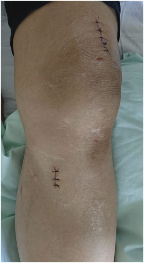 Early Results Of Intramedullary Nail Fixation In Distal Tibia Oblique