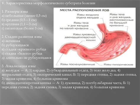 Язвенная болезнь желудка - презентация онлайн
