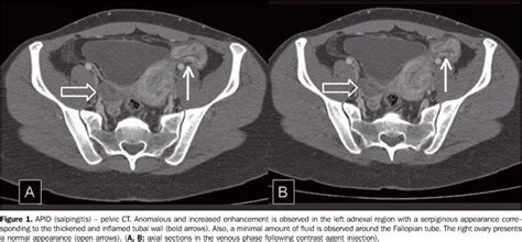 Reviews And Opinions In Emergency Medicine Pid Is Not Just An Std Get