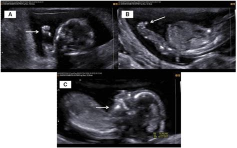 First Trimester Three Dimensional Ultrasonographic Diagnosis Of