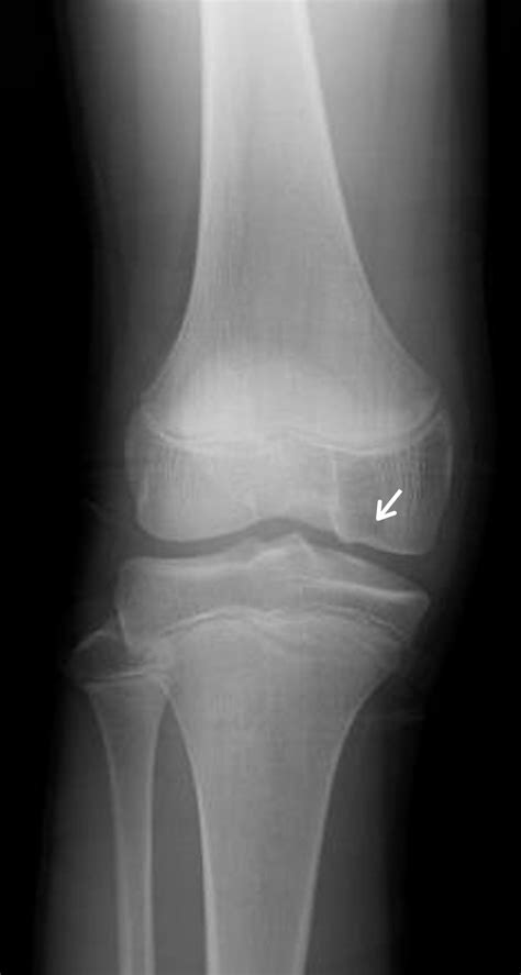 An Anteroposterior Radiograph Showed A Bone Defect In The Femoral