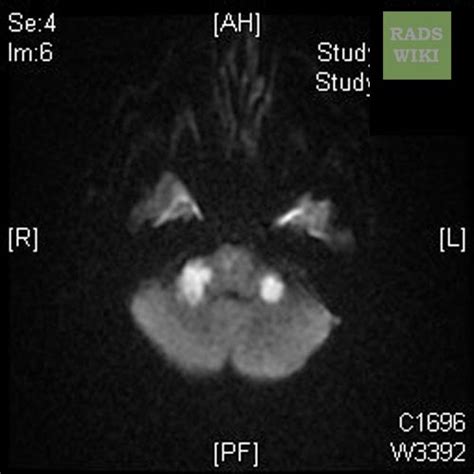 Ischemic Stroke Mri