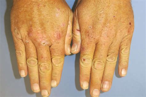 Hepatitis Rash Causes Symptoms And Treatment