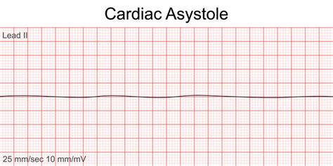 Asystole Rhythm Strip