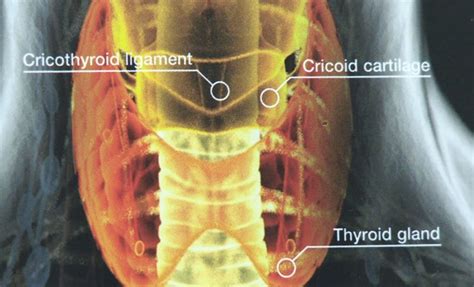 Graves Disease Symptoms And Treatment Piedmont Healthcare